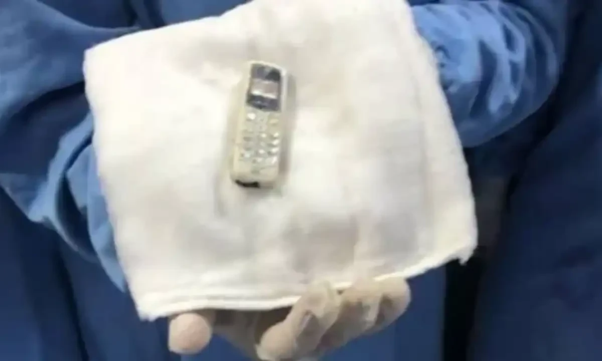 چھ سال بعد مریض کے پیٹ سے موبائل فون نکال لیا گیا