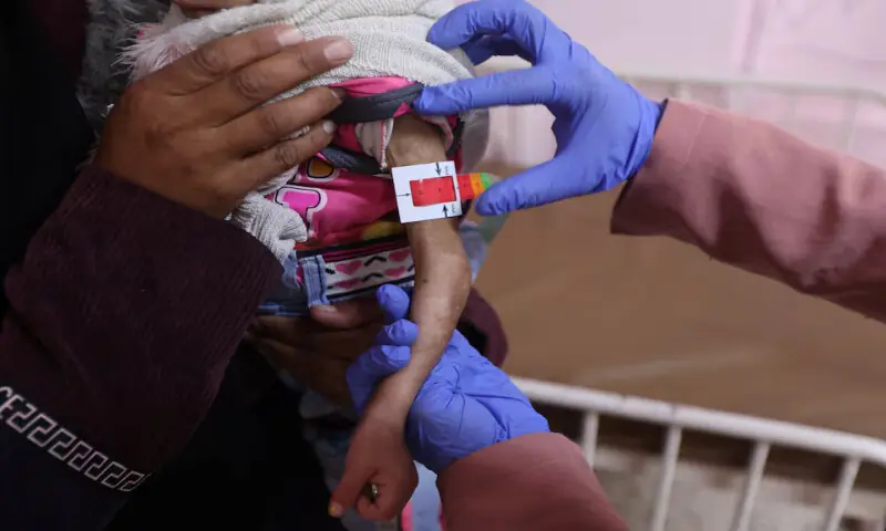 Arjwan Al Dahini, a Palestinian child, who doctors say suffers from severe acute malnutrition, is held by her mother during a medical examination at Nasser Hospital in Khan Younis, southern Gaza Strip. &ndash; Reuters
