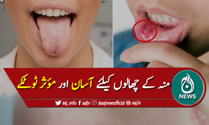 منہ، زبان یا ہونٹوں کے چھالوں کیلئے آسان اور مؤثر ٹوٹکے