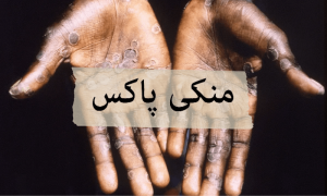 مَنکی پاکس وائرس کیا ہے، ہمیں فکر مند ہونا چاہئے؟