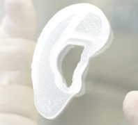 First living 3D ear succesfully transplanted