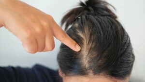 گرتے بالوں اور گنج پن سے بچانے والی غذائیں