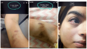 Aliza Sultan&rsquo;s bruises, medical report tell a tale of domestic violence