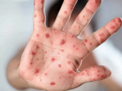 پاکستان میں منکی پاکس کی ویکیسن موجود نہیں، ادارہ صحت کی تصدیق