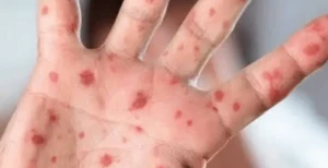 پاکستان میں منکی پاکس کے 2 مریض صحتیاب