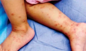 پنجاب میں اپریل سے مئی کے دوران 2 ہزار سے زائد خسرے کے کیسز