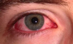 کراچی: آشوب چشم کی وبا میں تیزی سے اضافہ