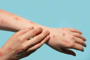 کراچی میں منکی پاکس کے 3 مشتبہ کیسز سامنے آگئے