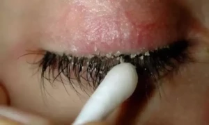 پلکوں کی خشکی ختم کرنے کے چند آسان طریقے