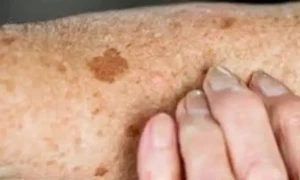 جلد پر سے بڑھتی عمر کے دھبوں کو ہٹانا اب صرف 2 چیزوں سے ممکن