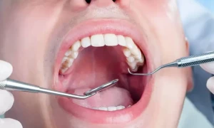 دانتوں میں ان علامات کو دیکھتے ہی ڈاکٹر کے پاس دوڑیں