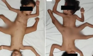 تین ہاتھ پانچ پاؤں والے انوکھے جڑواں بچے، ضروری اعضا کتنے؟