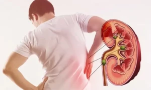 گردے میں پتھری سے بچانے والے سپر فوڈ