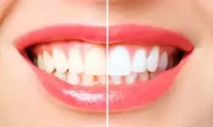 5 قدرتی جڑی بوٹیاں، جو دانتوں کو سفید کرنے میں مدد کرتی ہیں