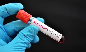 فرار کی خبر غلط نکلی، منکی پاکس کا مریض گھر میں ہی موجود
