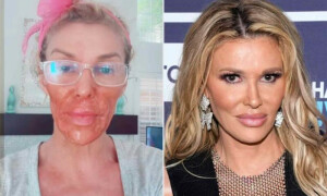 حسن بڑھانے کی کوشش میں بیوٹی ہیک مہنگا پڑ گیا، ماڈل کا چہرہ جھلس گیا