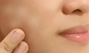 کیا جلد اور چہرے پر سفید دھبوں کی وجہ دھوپ ہے؟ماہرین نے حقیقت بتادی