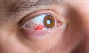 آنکھیں شوگر کا پہلا سگنل ہیں، انہیں نظر انداز نہ کریں