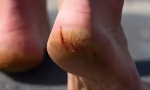 سردیوں میں ایڑھیوں کا پھٹنا جسم میں کس چیز کی کمی کا اشارہ ہے؟ سردیوں میں ایڑھیوں کا پھٹنا جسم میں کس چیز کی کمی کا اشارہ ہے؟