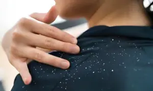 سردیوں میں بالوں کی خشکی اور کھجلی سے کیسے نجات پائیں؟