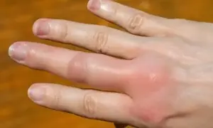 سردیوں میں ہاتھ اور پیر کیوں سوج جاتے ہیں؟