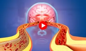 سردیوں میں فالج میں اضافے کی وجہ کیا ہے؟