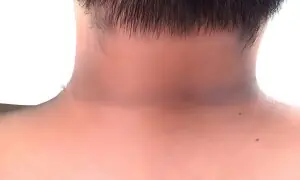 گردن پر سیاہ لکیریں میل نہیں سنگین بیماریوں کی خاموش وارننگ ہیں