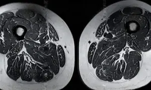 الٹرا پراسیسڈ غذاؤں سے انسانی رانوں میں خطرناک تبدیلی