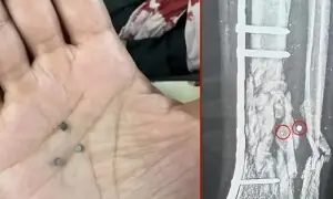 لبنان میں اسرائیلی &lsquo;کیمیکل بموں&rsquo; کا استعمال، زخمی شہریوں کے جسموں سے چوکور ذرات برآمد