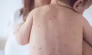 Third child dies of measles in a week in Kandhkot as family blames health department neglect Third child dies of measles in a week in Kandhkot as family blames health department neglect