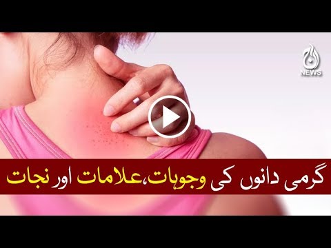 Prickly heat symptoms and treatment