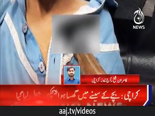 بچے کے سینے میں گھسا ہوا پیچکس نکال لیا گیا