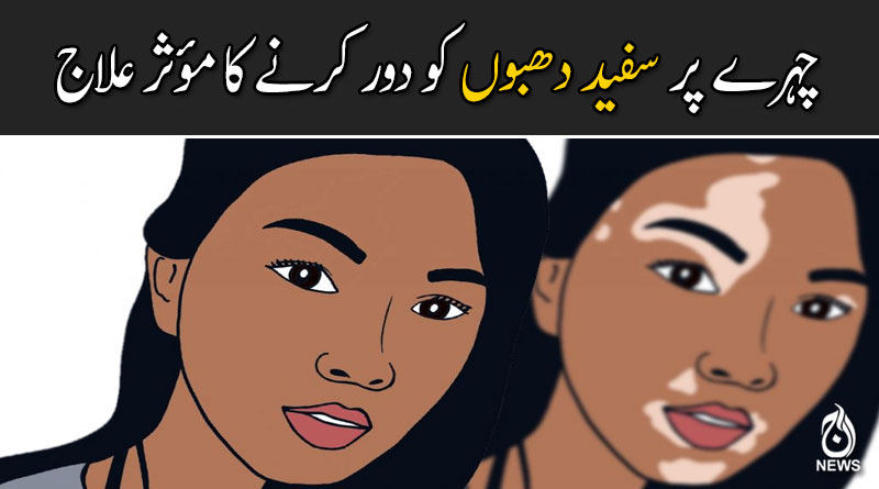 برص کے مرض کی وجہ اور اس سے بچاؤ