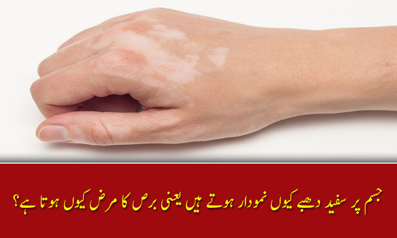 جسم پر سفید دھبے کیوں نمودار ہوتے ہیں یعنی برص کا مرض کیوں ہوتا ہے؟