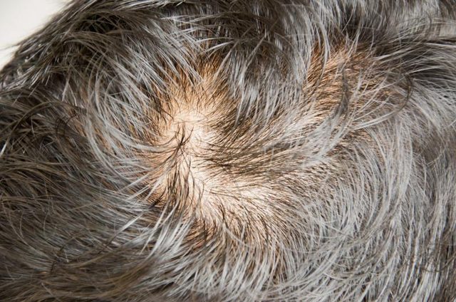 صرف دو اجزاء سے بھگائیں گنج پن کا مسئلہ