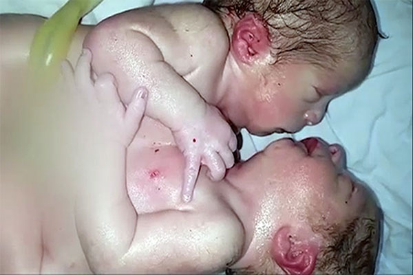 ملتان میں دھڑ جڑی بچیاں دم توڑ گئیں