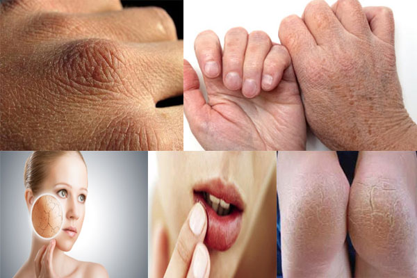 خشک جلد سے پریشان افراد جانئے ان میں کس وٹامن کی کمی ہے