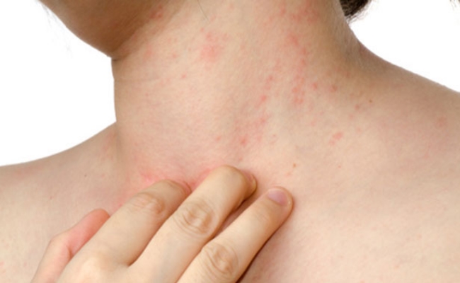 اب گرمی دانوں سے پریشان ہونے کی بالکل ضرورت نہیں