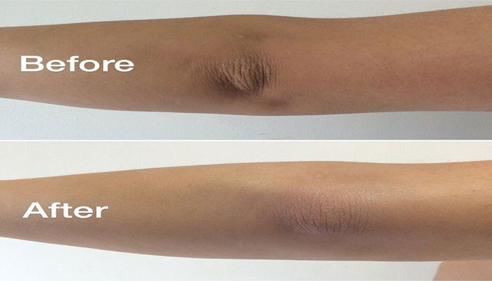 کہنیوں کا سیا ہ ہونا، کس بات کی علامت ہے؟