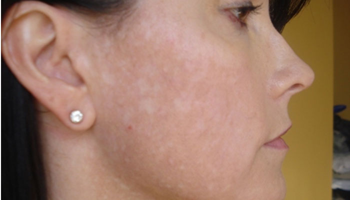 چہرے پر سفید دھبے صرف کیلشیم کی کمی سے نہیں ہوتے