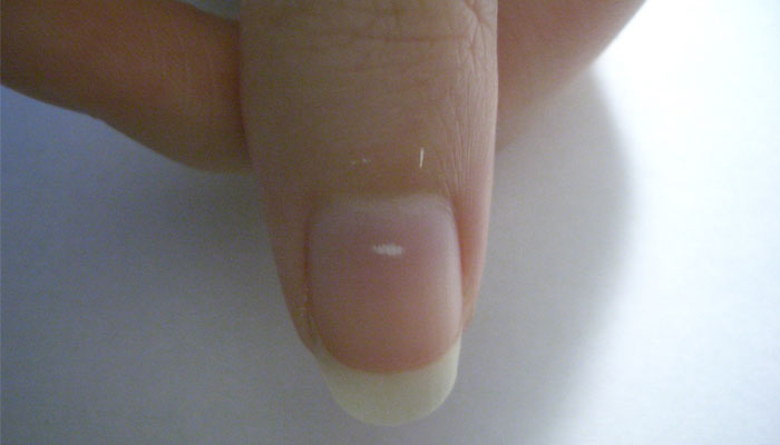 ناخنوں پر موجود سفید نشان کس چیز کی نشاندہی کرتے ہیں؟