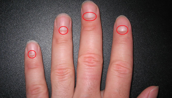 ناخنوں پر آدھے چاند کا بنا ہونا کس چیز کی علامت ہے؟