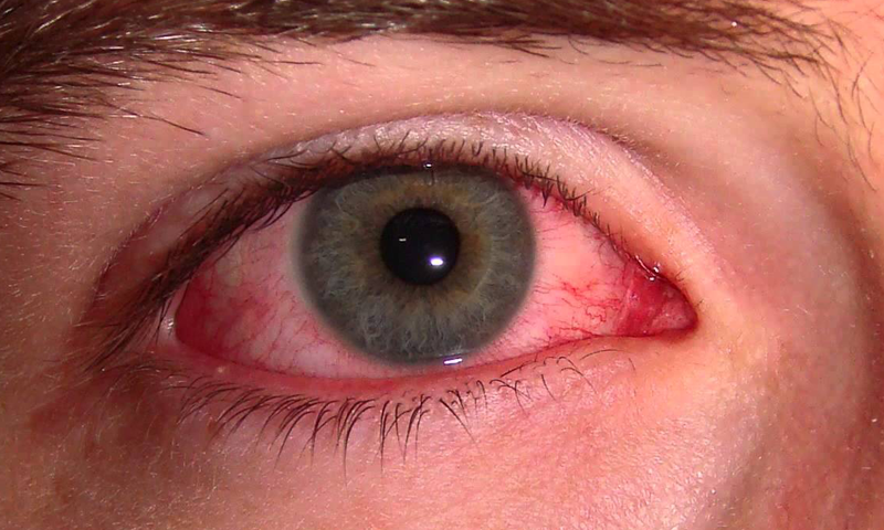 کہیں  آپ کی آنکھیں بھی تو سرخ نہیں ہو جاتیں؟