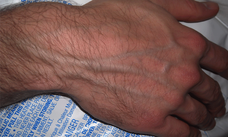 ہاتھوں کی نسوں کے پھولنے کے پیچھےکیا وجہ ہے؟