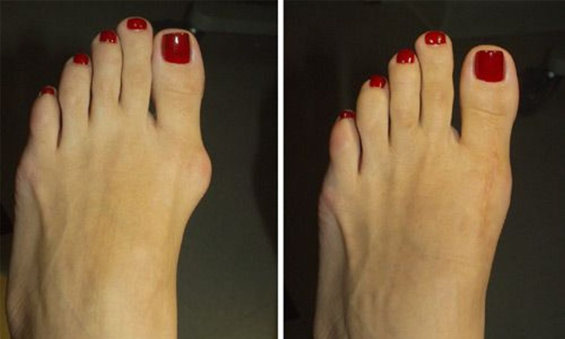 پاؤں کی ہڈی بڑھنے کے پیچھے کیا وجہ ہے؟