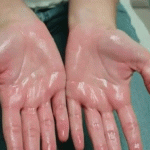 کیا آپ ہاتھوں پر بے تحاشہ پسینہ آنے کی وجہ سے پریشان ہیں؟