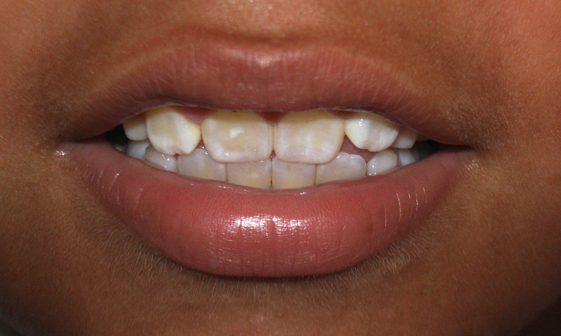 دانتوں پر سفید دھبوں کا ہونا کس بیماری کو ظاہر کرتا ہے؟