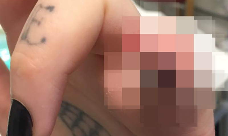 برطانوی خاتون نے خوبصورتی کیلئے انگلی کاٹ ڈالی