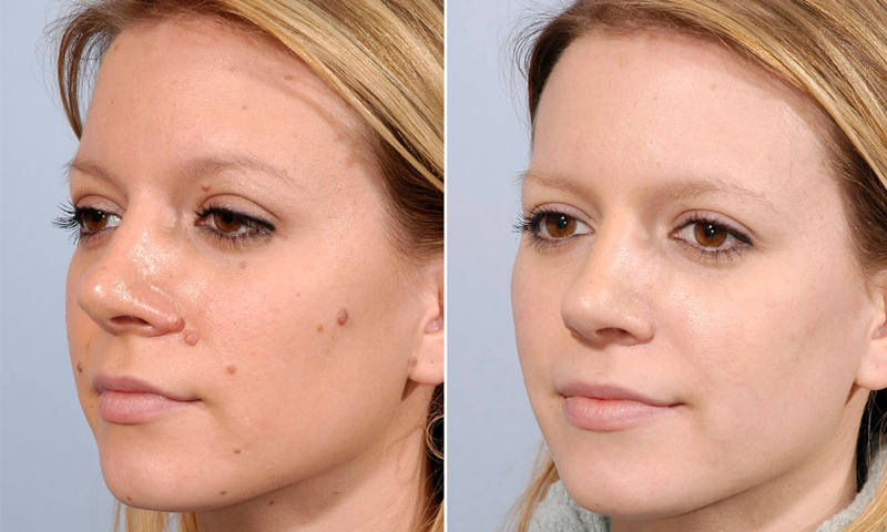 ان قدرتی طریقوں پر عمل کرکے چہرے اور جسم پرموجود تلوں سے چھٹکارہ پائیں