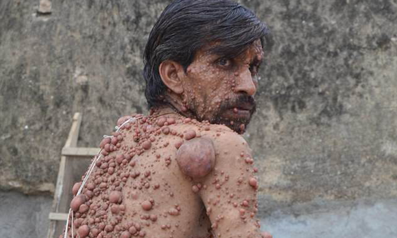 بھارتی شخص&nbsp; کی زندگی رسولیوں نے برباد کردی